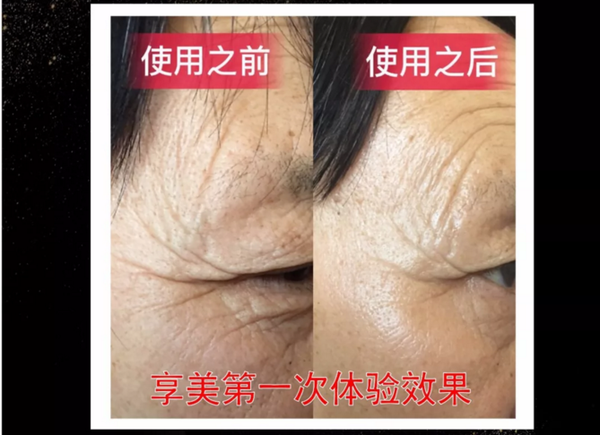 鄭州美博會(huì)_小黑瓶使用前后